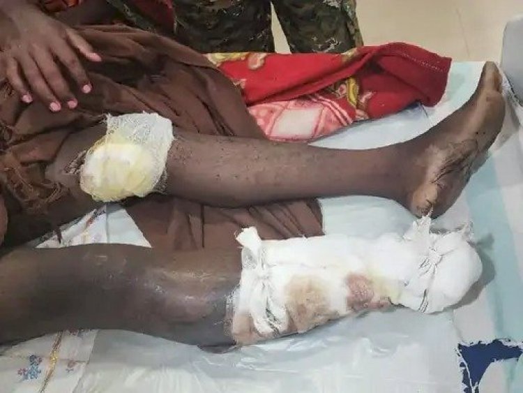 नक्सलियों की कायराना हरकत : IED की चपेट में आया युवक, पैर के उड़े चीथड़े, जख्मी युवक को नक्सलियों ने 17 दिन रखा बंधक, फिर जो किया.